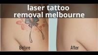 The Tattoo Removal Specialist in Melbourne image 2